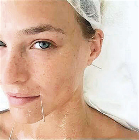 萊昂納多前女友、以色列內(nèi)衣超模芭兒·萊法利（Bar Refaeli）曾在社交平臺上分享了自己面部針灸時的樣子，照片中芭兒素顏正躺，臉上多個穴位規(guī)則布針。(美國《僑報》摘自網(wǎng)絡(luò)圖片)