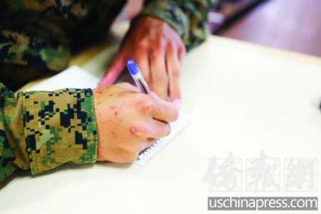 劉中杰手上已經(jīng)滿是傷痕。（美國《僑報》/陳沉 攝）