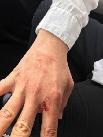 一名疑似西裔男子于21日下午進(jìn)入成先生在芝加哥華埠的租住房行竊被抓現(xiàn)行，住戶督先生手部受傷。(成先生提供) 