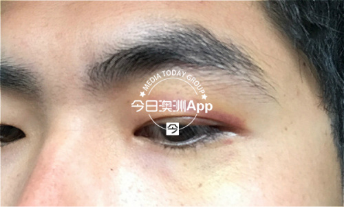 小陽被打傷1周后的照片 小陽被打傷1周后的照片