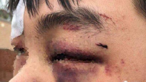 銳參考｜中國在這個國家的所有使領(lǐng)館，首次“群發(fā)”了同一個警告 遭受毆打的中國留學(xué)生(圖片源自澳媒)