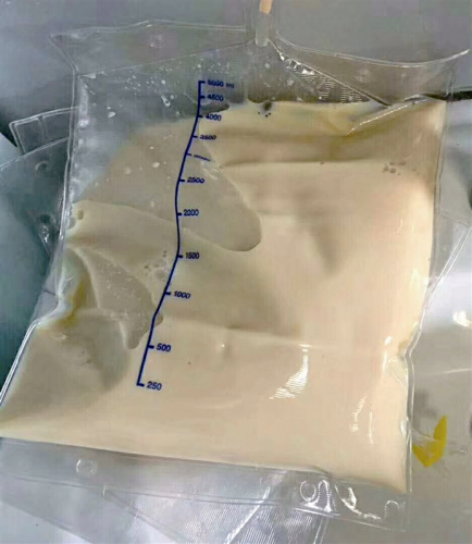 小萍體內(nèi)置換出的血漿像豬油一樣 院方供圖。