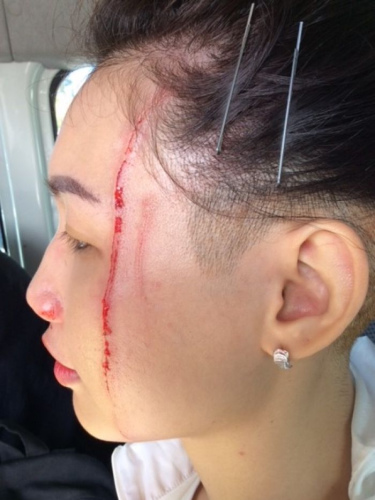 有游客被袋鼠襲擊后，頭破血流。 澳洲廣播公司