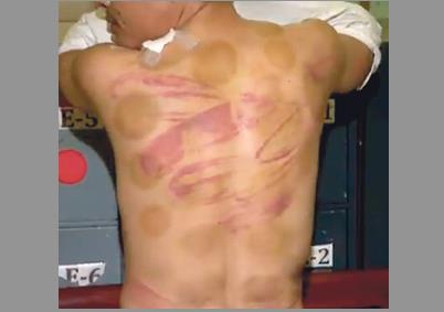  受害人背部傷痕累累。(菲律賓《世界日報(bào)》)