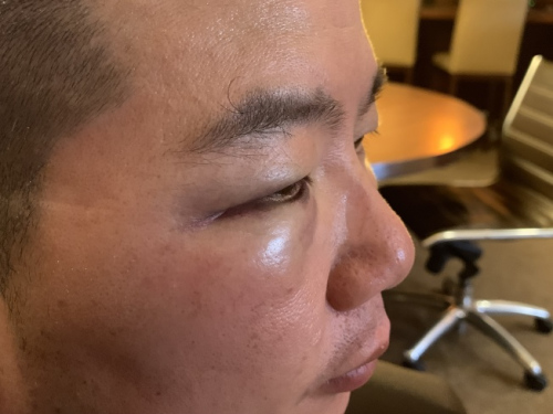 華裔家庭日前在法拉盛遭非洲裔侮辱、攻擊、性騷擾、砸車，華裔父親臉部被揍多拳，右眼瘀青腫漲嚴(yán)重。(來(lái)源：美國(guó)《世界日?qǐng)?bào)》記者賴蕙榆 攝 )