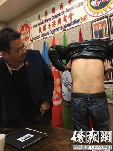 受害華青之一向布碌侖亞總會會長陳善莊求助,展示被打慘狀(僑報記者