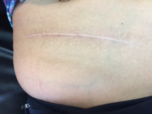 劉女士身上的其中一個(gè)傷口被縫了很多針。(美國《世界日報(bào)》)