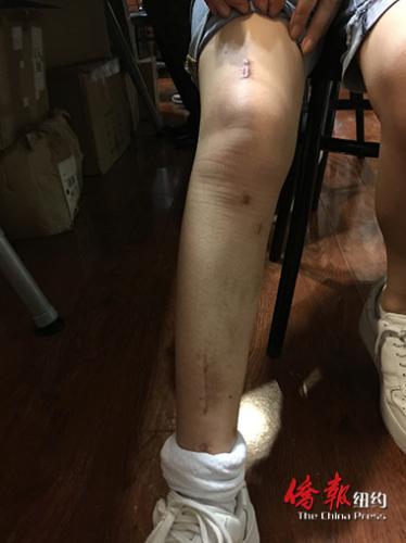 嚴重骨折的陳女士至今未從右腿的傷痛中康復過來。(美國《僑報》/崔國萁