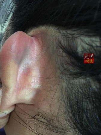 林偉勸妻子的后腦遭匪徒持刀柄敲傷,耳后出現(xiàn)淤血。(馬來西亞《光華日報》)