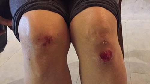 中國僑網(wǎng)老婦雙腳膝蓋都有擦傷的痕跡。(馬來西亞《星洲日報》)