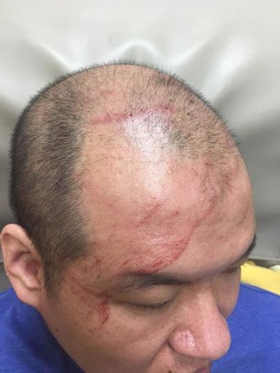 中國僑網(wǎng)莫名被毆打,江賢鋒渾身是傷。(美國《世界日報》/黃伊奕 攝)