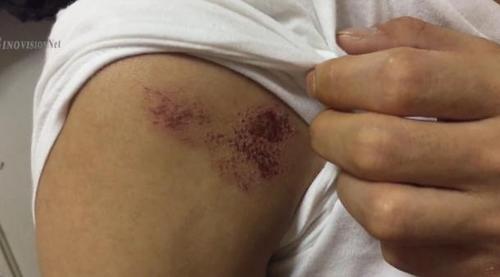 中國僑網(wǎng)被打淤青。(美國中文網(wǎng))