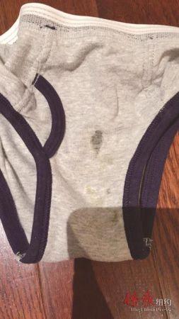 中國僑網(wǎng)蘇女士4歲半小兒的下體疑似被同幼兒園小朋友打傷,膿水浸濕底褲。(美國《僑報》/蘇女士供圖)