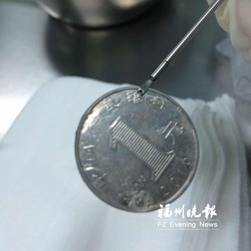 中國僑網(wǎng)取出的卡在食道的硬幣