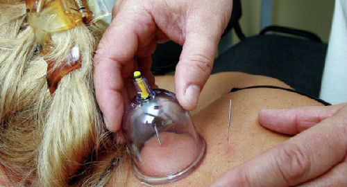 俄羅斯老人在中國進(jìn)行中醫(yī)理療。(圖片來源:俄羅斯衛(wèi)星網(wǎng))