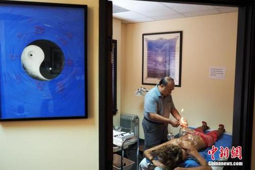 中國(guó)僑網(wǎng)資料圖:圖為在美國(guó)行醫(yī)20余年,身為清代著名中醫(yī)溫病學(xué)家吳鞠通的第七代傳人的吳寶林為患者拔火罐。中新社發(fā) 毛建軍 攝